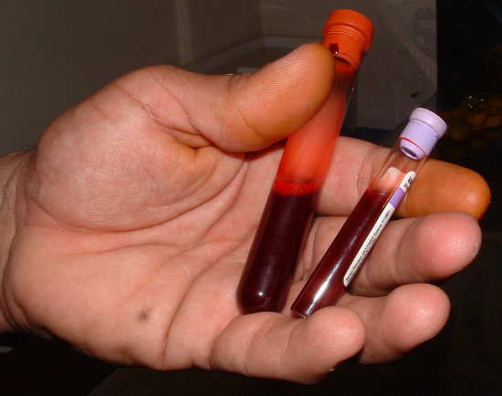 Blood samples in vials